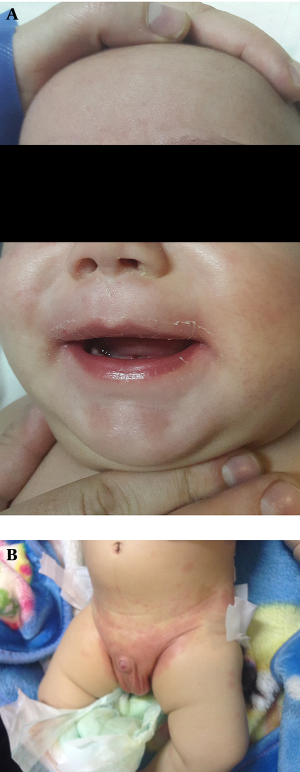 A, Dried and cracked erythematous lips with perioral peeling; B, intense macular rash, in the diaper area.