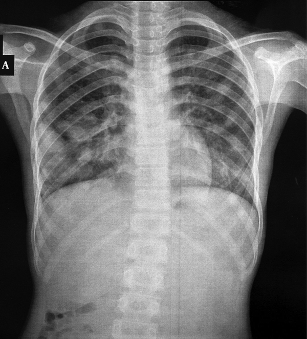 The AP- Chest X-Ray Shows Multiple Bilateral Spherical Lesions of Varying Size that are Predominantly Peripherally Located in Right Lung.