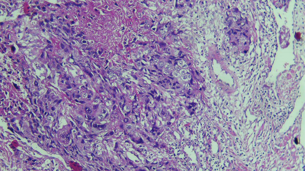 Endometrial Curettage Shows a Biphasic Arrangement of Clear Cytotrophoblasts and Syncytiotrophoblasts with Invasion Into Superficial Myometrium (H&E stain)