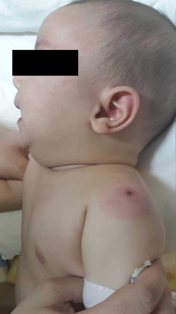 Erythema at the Site of BCG Inoculation