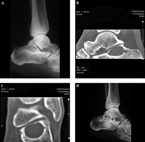 A, Normal Appearing X-Ray of the Left Ankle Joint; B and C, Computerized Tomography Scan of the Left Ankle Showing Single Lytic Bone Lesion in the Calcaneus Without Surrounding Periosteal Reaction; D, X-Ray of the Left Ankle Joint Following Bone Cement Filling