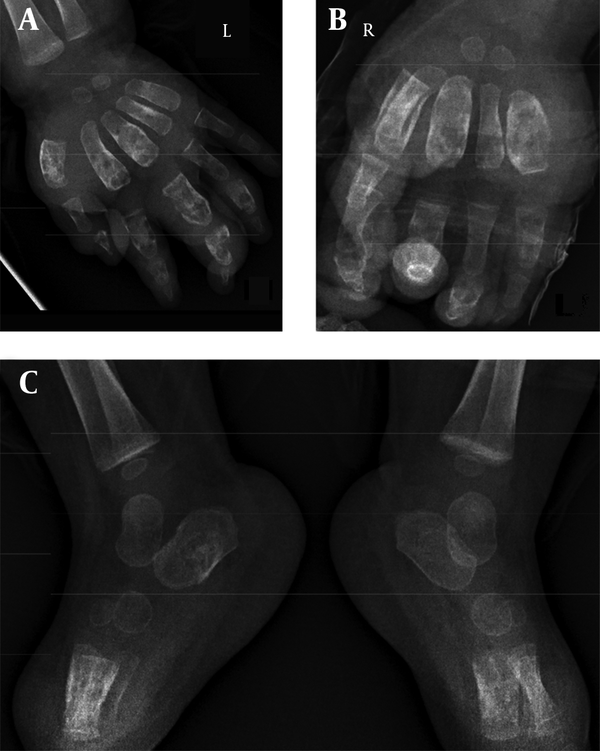 A and B, Lytic bone lesions with expansion in right and left hands; C, Osteopenia and lytic bone lesions in right and left feet.