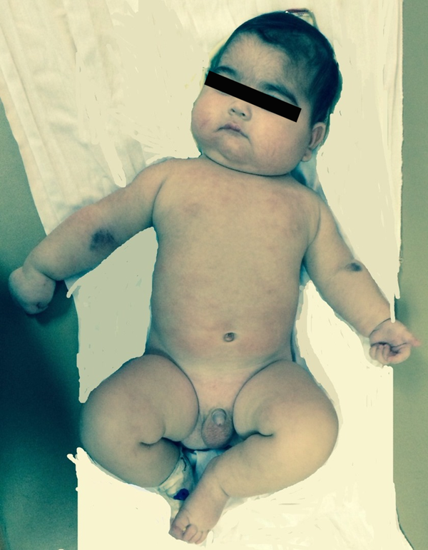A 4-Month-Old Boy Referred Due to Cushingoid Face