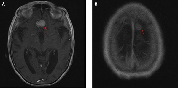 A, A 2.2 cm homogeneous enhancing mass of the planum sphenoidale suggestive of meningioma; B, A 0.9 cm enhancing nodule in the left frontal convexity, compatible with meningioma.