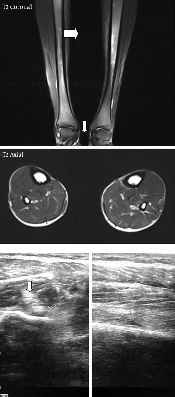 An 18-Year-Old Patient with Grade 2 Findings on MRI (A) with corresponding USG Findings (B).