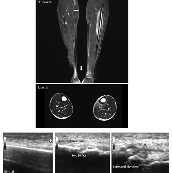 A 20-Year-Old Patient with Grade 4 MRI Findings (A) with Corresponding USG Findings (B).