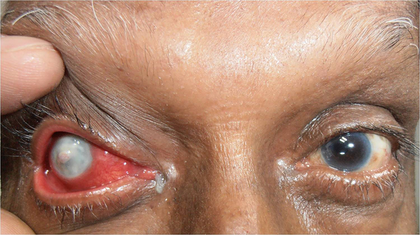 Right Eye Revealing Well Localized Whitish Infiltrate with Surrounding Edema Covering Entire Cornea.