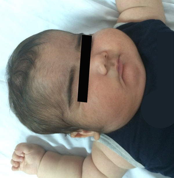An 11-Month-Old Boy (Case 1) Presenting With a Moon Face Appearance and Telangiectasia on the Cheeks