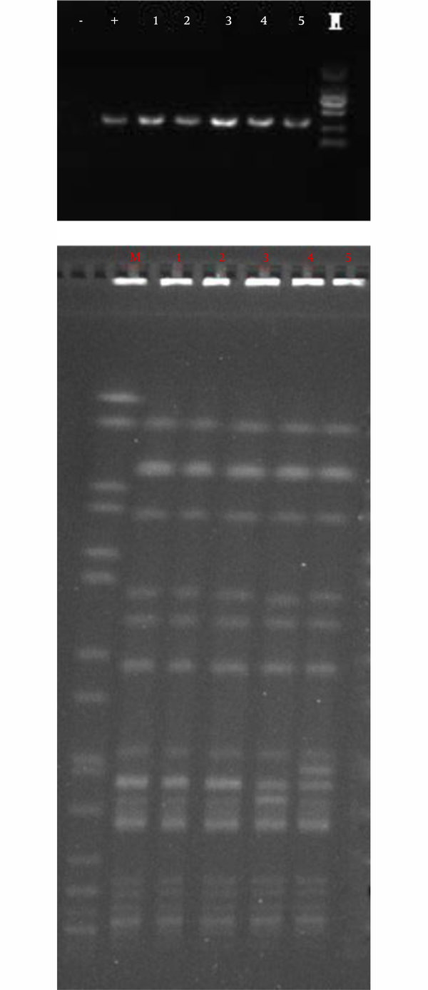 A, PCR of blaKPC Gene of Five K. pneumoniae Isolates. Lane -: Negative Control, Lane +: Positive Control, Lane M: Marker DL 2000; B, PFGE of Five K. pneumoniae Isolates. Lane M: Salmonella Serotype Braenderup H9812. Lane 1 ~ 5: K. pneumoniae Isolated from Stool, Blood, Sanies, Throat Swab, and Urine