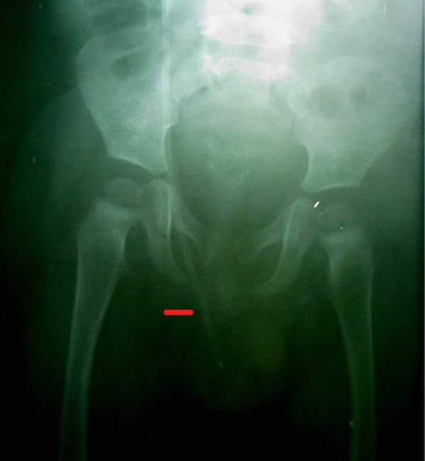 X-ray of peritoneal catheter displacement into scrotum through inguinal canal; red pointer indicates opaque peritoneal catheter.