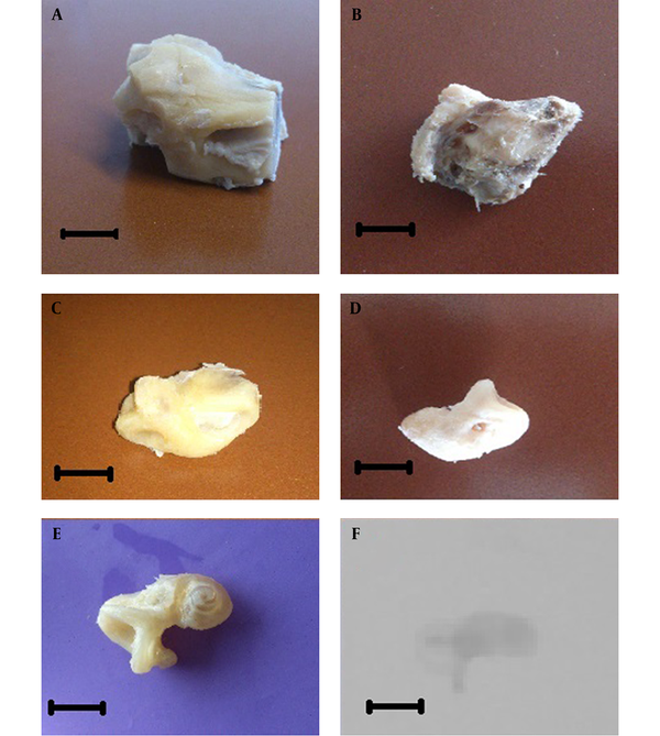 A, The temporal bone was cut in cube form; B, Excessive bony and soft tissues were removed grossly (sample weight: 13 - 14 g); C, Intermittent decalcification with 5% nitric acid and drilling were performed (down to 6 g sample); D, The decalcification with 20% EDTA and drilling were continued (down to 3 g); E, The decalcified labyrinth; F, Complete decalcification of the sample was confirmed by X- ray imaging. The scale bars represent 1 centimeter.