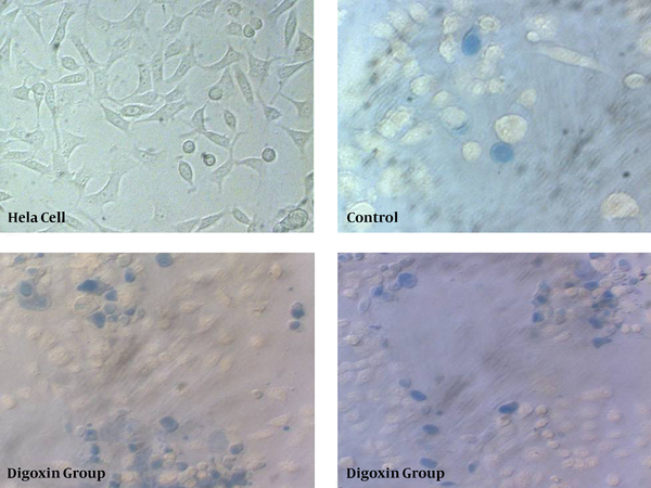 The intact HeLa cells have been shown in upper and right side of the figure. The blue cells are less in control group while the dead cells are more seen in two experimental groups with different 3 and 10 µM digoxin after 24 hour.