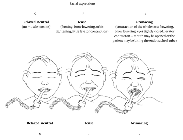 Facial Expression Tool for Pain Assessment, Drawings by Caroline Arbour, RN, B.Sc., PhD (student), McGill University