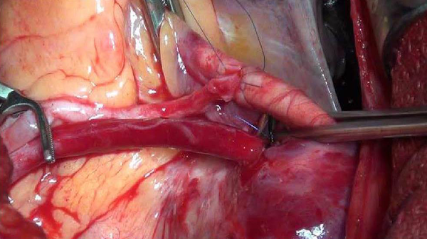 Performing the Proximal Venous Graft Anastomosis by Multiple Partial Occlusion of the Ascending Aorta (Side Biting Technique).