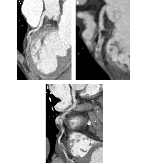 A 67-year- old man with a mean heart rate of 73 beats/min and heart rate variability of 6 beats/min. A - C, Curved multiplanar reformations of the left anterior descending (A), left circumflex (B), and right (C) coronary arteries show nondiagnostic image quality.