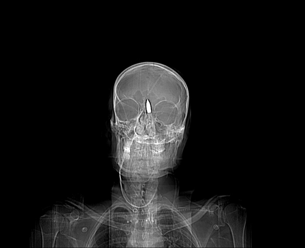 The Anteroposterior View of the Patient with a Bullet in the Midline Position