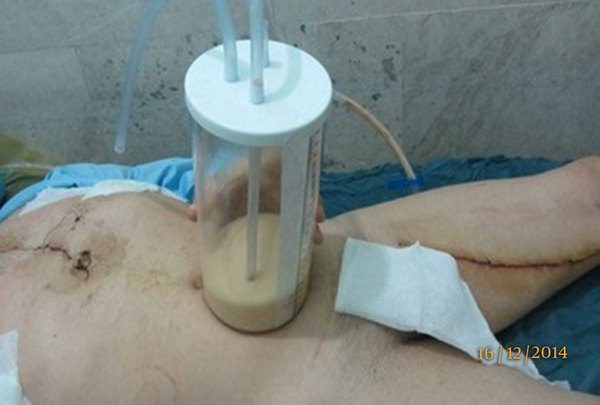 Shows Midsternotomy and Saphenous Vein Graft Harvesting Site Incisions with Milky Effusion in Chest Bottle