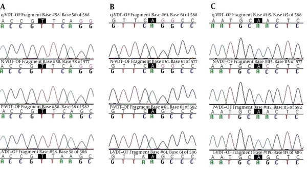 Sequence Alignment of pvdhfr Gene at Codon 57 (A), Codon 58 (B) and Codon 117 (C)