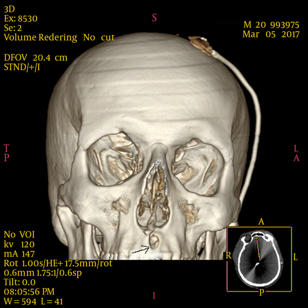 The 3D CT Scan of the Skull and Face Revealing the Site of Bullet Entrance to the Maxilla