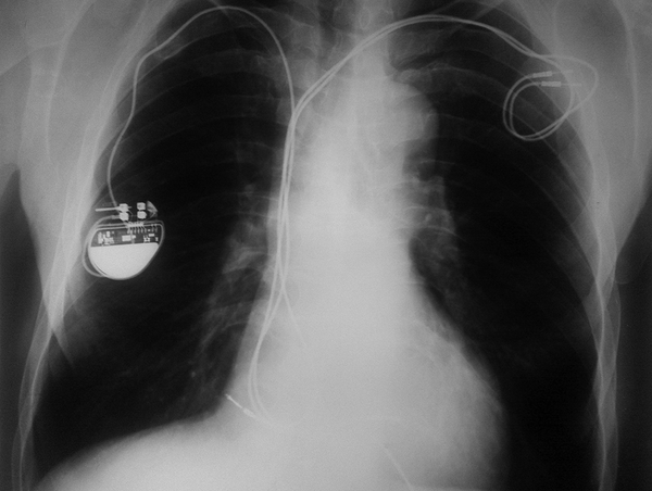 Pre-operative Chest x-Ray Showing a Dual Chamber Leads (Thick Arrow) and a Single Chamber Permanent Pacemaker (Narrow Arrow)