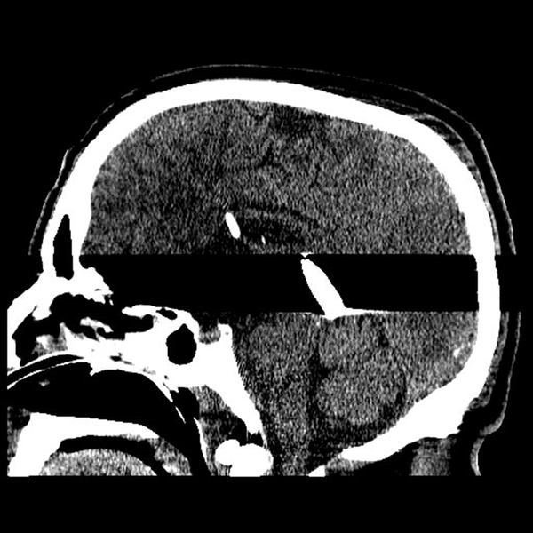 The Sagittal View of Brain CT Scan Showing Bullet Entrapment in the Posterior Region of the Third Ventricle with Compression on the Pineal Region and Aqueduct of Sylvius Causing Hydrocephalus