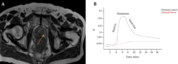 A, Axial T1W image shows high signal intensity (SI) mass in the left peripheral zone (arrow); B, Time-intensity curve for both normal tissue and prostate cancer.