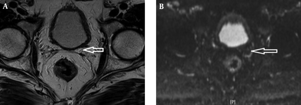 A 65-year-old man with prostate cancer. A, Axial T2W MR image (T3a, gleason score (GS): 7); B, Corresponding apparent diffusion coefficient (ADC) map calculated from diffusion weighted imaging (DWI). Arrows show prostate cancer in the left peripheral zone.