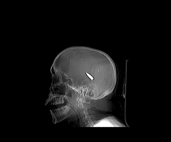 The Lateral Skull View of the Patient with an Intracranial Bullet