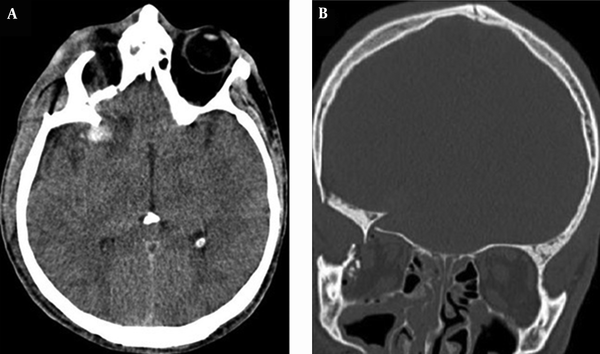 Brain CT Scan Shows the Right Temporal and Insular Lobe Contusions (A) Due to Posterior Displacement of the Avulsed Sphenoid Wing (B)