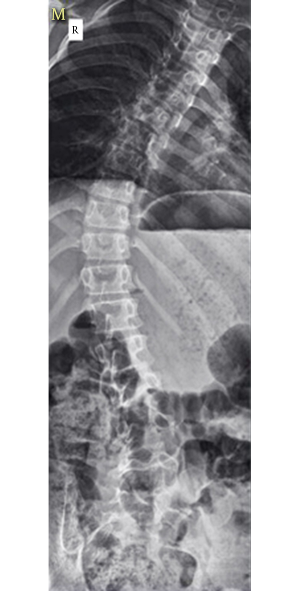 Preoperative Anteroposterior Spine X-Ray