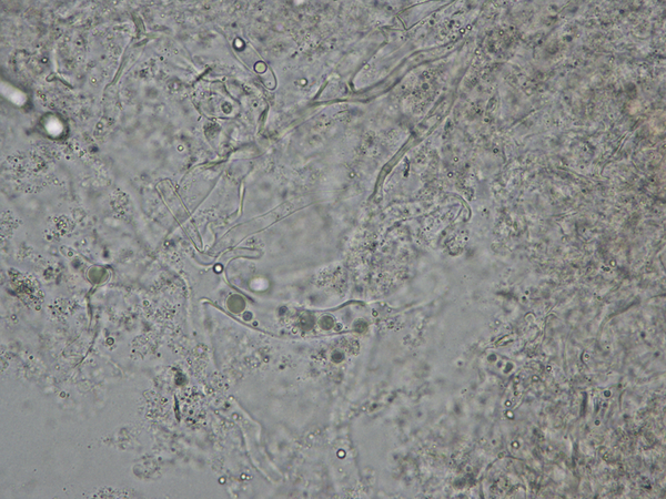 KOH Mount Showing Broad Aseptate Hyaline Hyphae Branching at Acute Angle and in Addition Few Branched Septate Dematiaceous Hyphae (400 X)