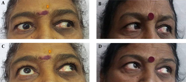Left column, A, and C are mid treatment showing restriction of adduction and elevation of adducted right eye respectively. Right column, B and D show full recovery of adduction and elevation of adducted eye