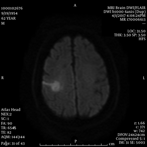 Brain MRI Diffusion Weighted Image Shows Diffusion Restriction in the Right MCA Territory Consistent with Acute to Subacute Infarct