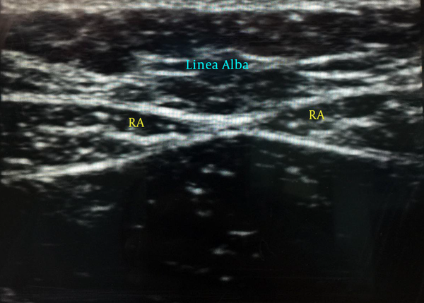 The linea alba is first viewed while placing the ultrasound below the xyphoid process. Bilateral rectus abdominis (RA) muscles are viewed.