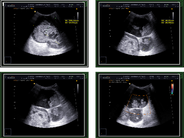 Ultrasonography of the Patient’s Right Breast Showing Cystic-Solid Lesions with Thick Walls Interspersing Them