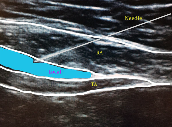 TA, transverse abdominis muscle; RA, rectus abdominis muscle. The needle is inserted in the fascial plane between the TA muscle and RA muscle. As shown in this image, local anesthetic injection should cause separation of TA and RA muscles. The injection is medial to the semilunaris in this image.