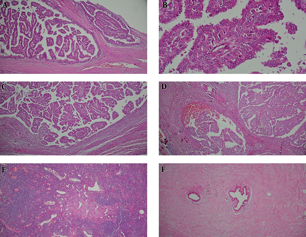 A, dilated cystic spaces with papillary projections; B, malignant papillary frond; C and D, invasive component associated with stromal reaction; E, lymph node sinus vascular transformation; F, fibrous mastopathy in none tumoral breast tissue.