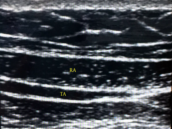 As the ultrasound is directed down the costal margin, the transverse abdominis (TA) muscle comes into view. RA, rectus abdominis.