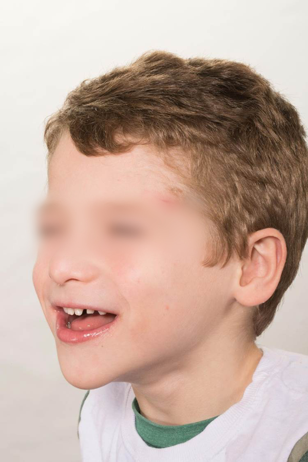 Patients with Angelman Syndrome are Known to Have a Good-Natured Disposition with Frequent Smiling and Laughing, which Can Confound Assessments of Postoperative Pain