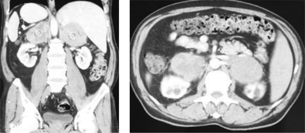 Abdominal CT Scan Showing Large Bilateral Adrenal Masses