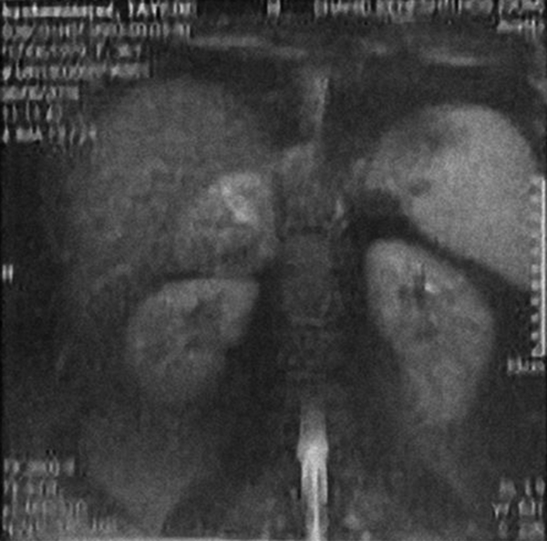 T2W MRI, Right Heterogeneous Adrenal Mass