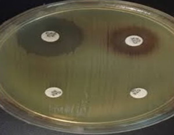 ESBL Detection in Acinetobacter baumannii by Combination Disk Test (CDT) Method