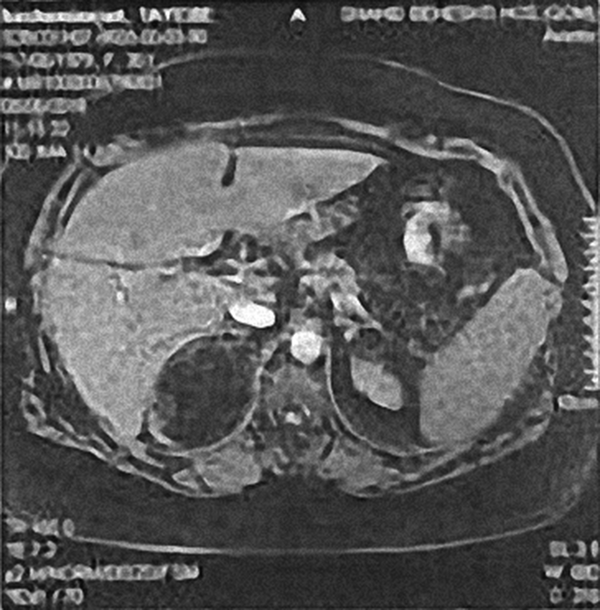 Abdominal CT, Right Adrenal Heterogeneous Mass with Variable Central and Peripheral Attenuation