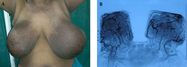 A, Lump Measuring Approximately 15 × 15 cm in the Right Breast and 15 × 13 cm in Left Breast With Skin Discoloration; B, Magnetic Resonance Imaging Breast With Angiography Revealed Bilateral Multinodular Masses in all Quadrants With Increased Angiogenesis.