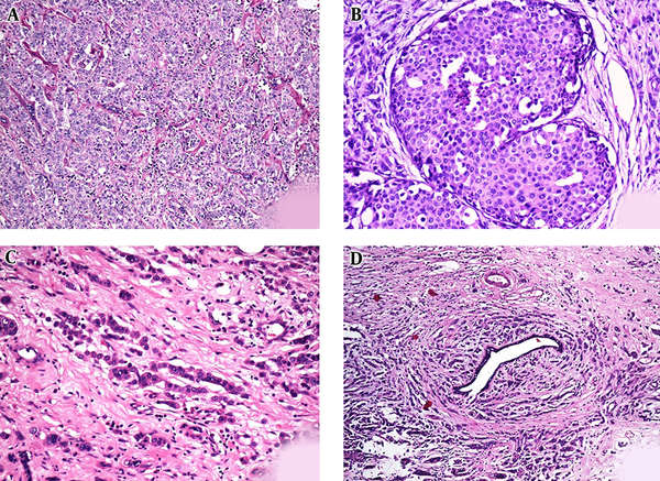 Hematoxylin and Eosin Stained Sections from Bilateral Breast Lesions Showed A, Invasive Lobular Carcinoma Disposed in Sheets with Cells Showing Minimal Pleomorphism; B, Lobular Carcinoma In Situ; C, Indian File Pattern; D, Tumor Cells Arranged in Concentric Fashion Around Normal Ducts (Targetoid Pattern).