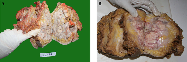 Bilateral tumor involved all four quadrants of the breast, hard in consistency, tan white in colour with foci of haemorrhage and necrosis