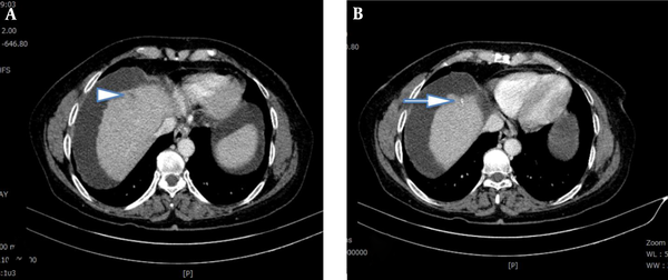 CT Scan of Liver Reveals (A) a Small Linear Subcapsular Hypodense Lesion (Arrowhead) (B) Associated with Adjacent Linear Calcification (Arrow)