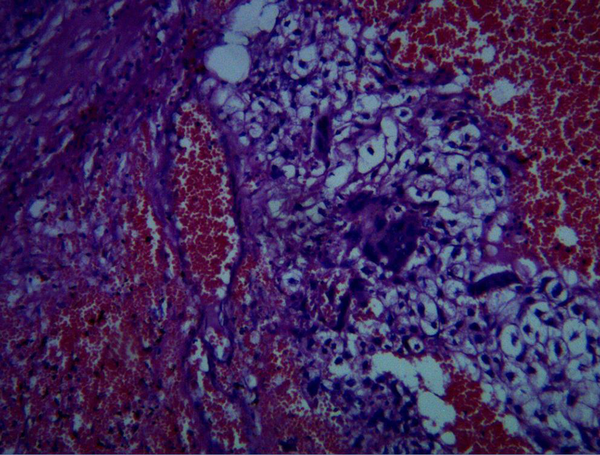 Microscopic View of the Tumor Specimen Sent for Pathologic Examination, Indicating an Ovarian Choriocarcinoma
