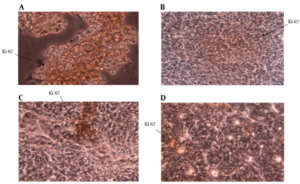 Expression of Ki67 in Tumor Tissue; Ki67 expression in tumor tissue was analyzed by immunohistochemistry method. A, Expression of Ki67 in control group; B, Expression of Ki67 in IL-12 group; C, Expression of Ki67 in GM-CSF group; D, Expression of Ki67 in IL-12 + GM-CSF group Expression of Ki67 was reduced in IL-12 + GM-CSF group compared with other 3 groups.