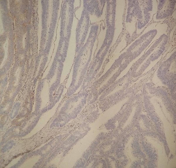IHC Staining Showing Low Expression of CD44 (< 10% of Tumoral Cells are Stained by CD44), (20x)